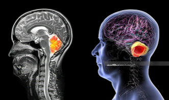 Anatomia Seccional por RM e TC - Neuroanatomia, Cabeça, Pescoço e Coluna Vertebral.