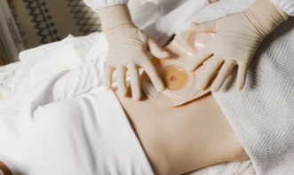 ENFERMAGEM EM ESTOMATERAPIA