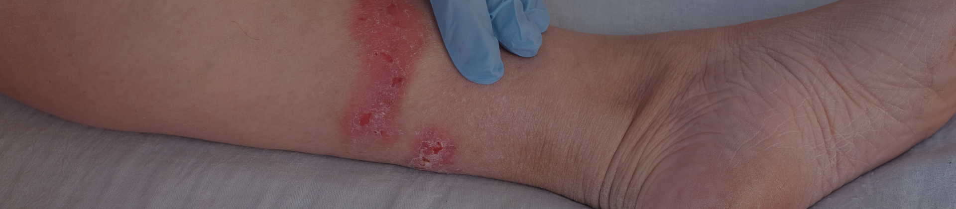 Assistência de Enfermagem ao Paciente com Úlceras Vasculogenicas