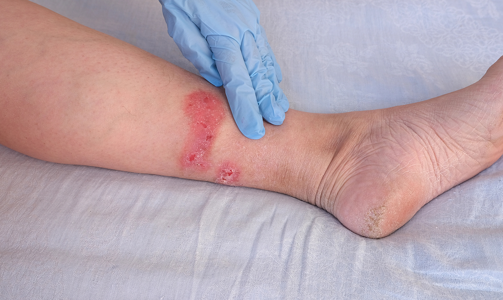 Assistência de Enfermagem ao Paciente com Úlceras Vasculogenicas