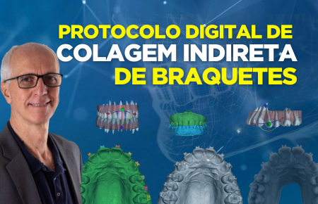 Protocolo Digital de Colagem Indireta de Braquetes