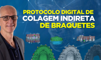 Protocolo Digital de Colagem Indireta de Braquetes